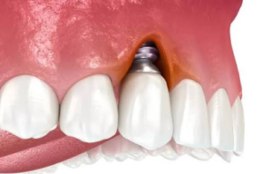 Peri Implantitis Explained: The Implant Version Of Gum Disease